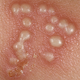 Illustration for article titled Obat Penyakit Herpes